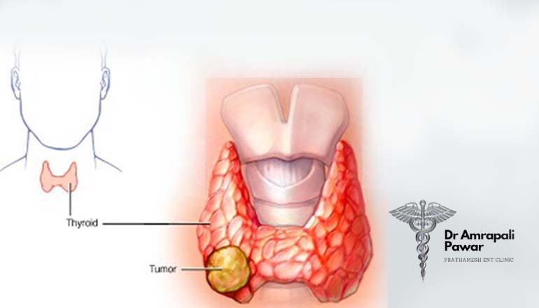 Thyroid Doctor in Santacruz